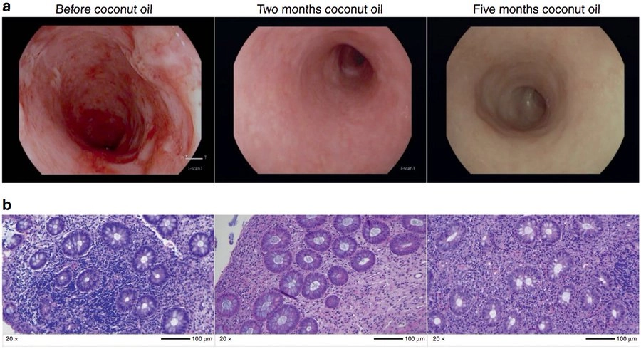 Coconut oil treating Crohn's study
