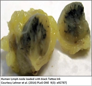 Human lymph node loaded with black tattoo ink